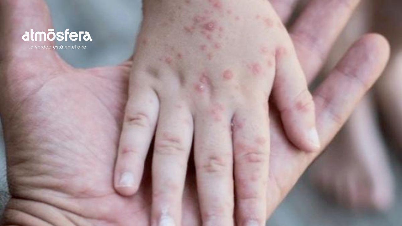 Brote de Coxsackie afecta a la mitad de niños en curso de verano de Happy Kids